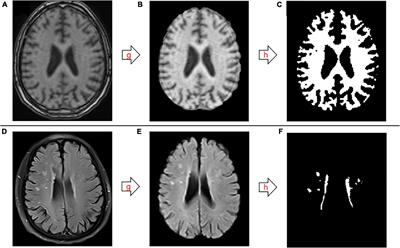 Value of white matter hyperintensity volume and total white matter volume for evaluating cognitive impairment in patients with cerebral small-vessel disease